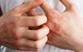 Vermelhidão, ressecamento, lesões e coceira: pode ser dermatite atópica
