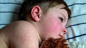 Cobertura Vacinal em Queda: O Risco de Retorno do Sarampo no Brasil em 2026