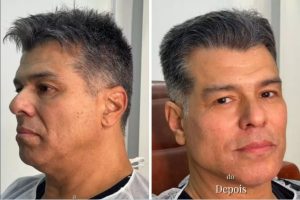 Harmonização Facial: como eliminar o ar de cansaço do rosto com procedimentos estéticos modernos