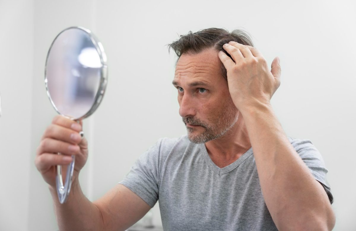 Calvície Masculina: Novos Tratamentos Oferecem Alternativas Além do Transplante Capilar