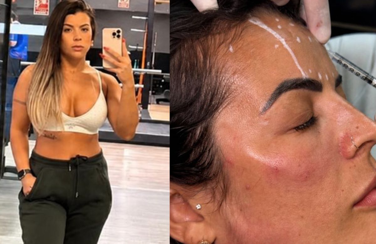 Ex-Miss Bumbum Recorre a Botox no Corpo para Controlar Excesso de Suor na Rotina Fitness